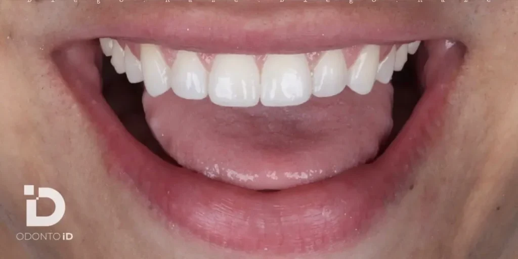 Sorriso depois do tratamento com lentes de contato dental