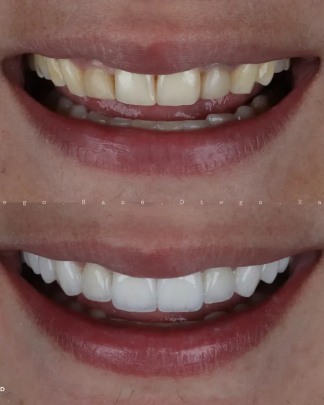 Documentação clínica de lentes de contato dental, antes e depois