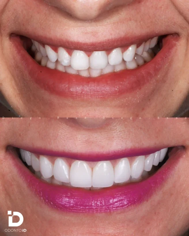 Documentação clínica de lentes de contato dental, antes e depois